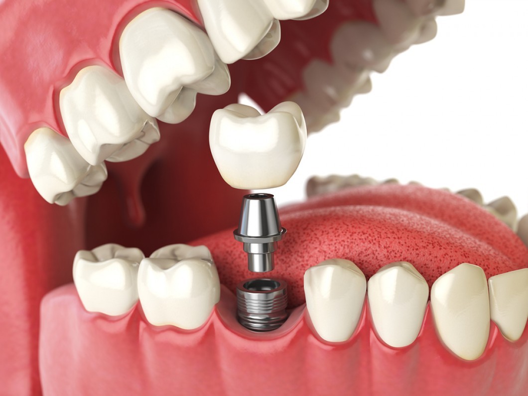 Model de implant dentar